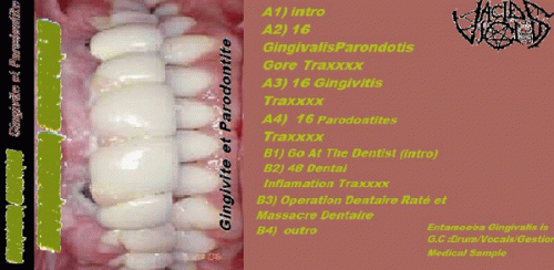 Gingivite et Parodontite